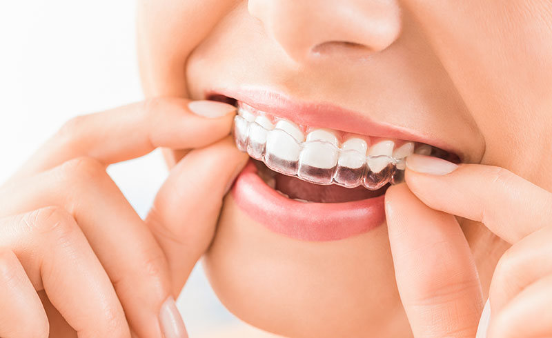 Invisalign1