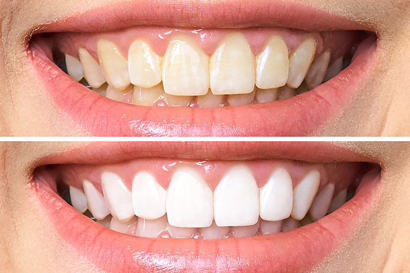 Teeth-Whitening1